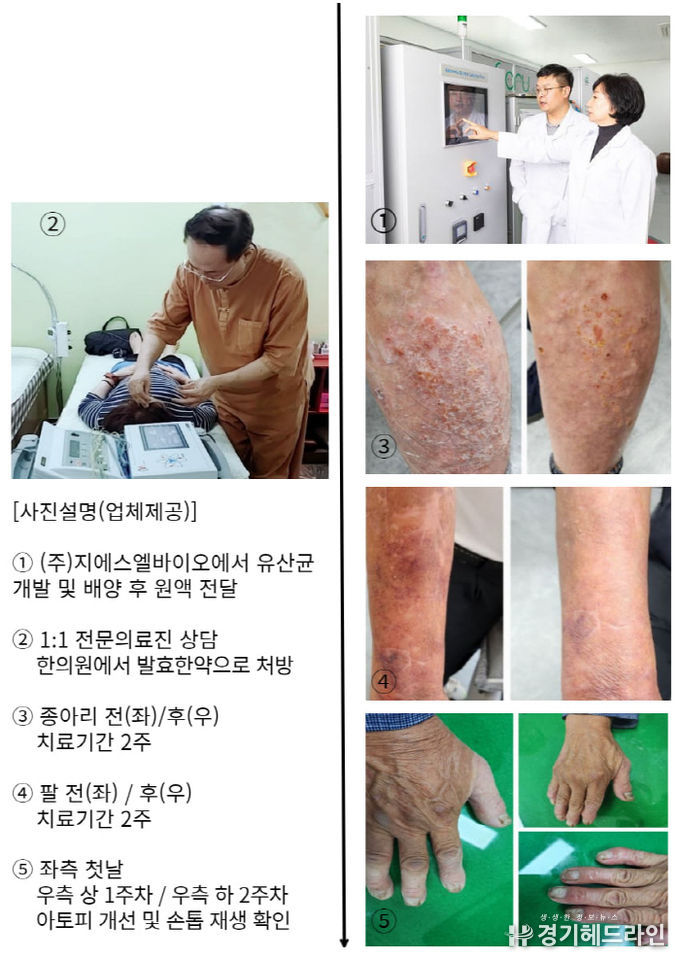 사진 설명 : 유산균을 통한 천연치료 주요 과정 및 임상결과